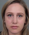 after rhinoplasty female patient front view case 5648
