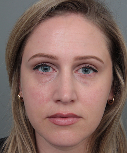 after rhinoplasty female patient front view case 5648