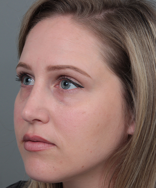 after rhinoplasty female patient left angle view case 5648