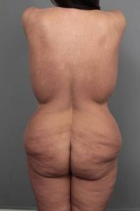 before butt lift back view female patient case 5805