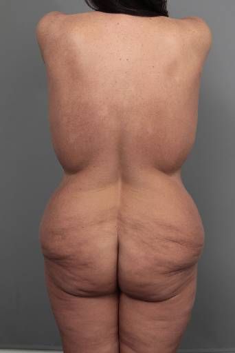before butt lift back view female patient case 5805