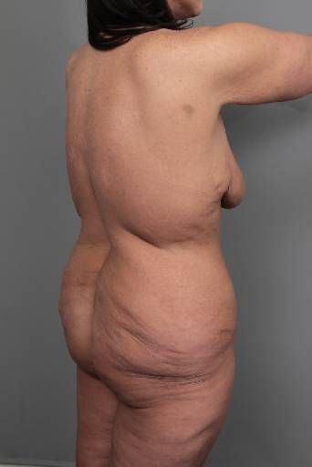 before butt lift angle view female patient case 5805