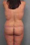 after butt lift back view female patient case 5805