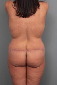 after butt lift back view female patient case 5805