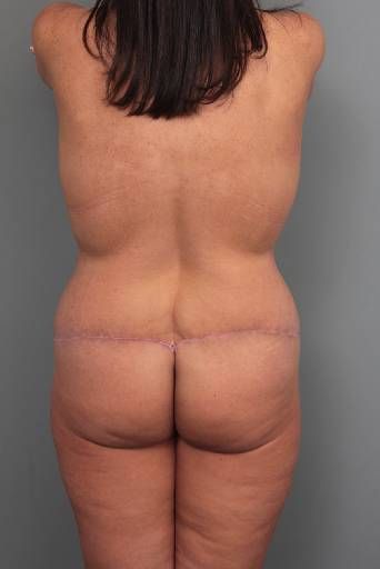 after butt lift back view female patient case 5805