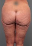before butt lift back view female patient case 5810