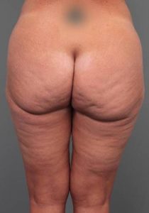 before butt lift back view female patient case 5810