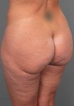 before butt lift angle view female patient case 5810