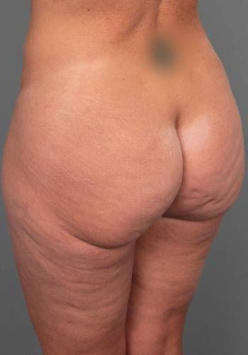 before butt lift angle view female patient case 5810
