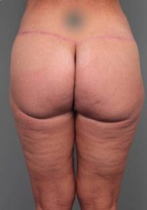 after butt lift back view female patient case 5810