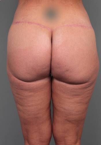 after butt lift back view female patient case 5810