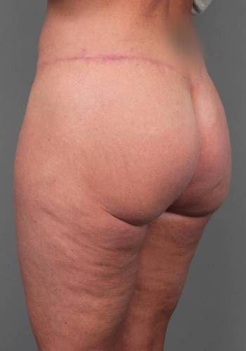 after butt lift angle view female patient case 5810