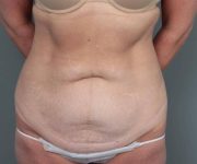 before tummy tuck front view female patient case 4286