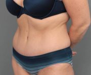 after tummy tuck angle view female patient case 4286