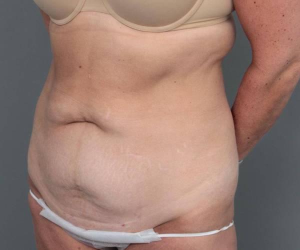 before tummy tuck angle view female patient case 4286