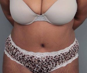 after tummy tuck female patient front view case 4295