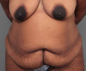 before tummy tuck female patient front view case 4295