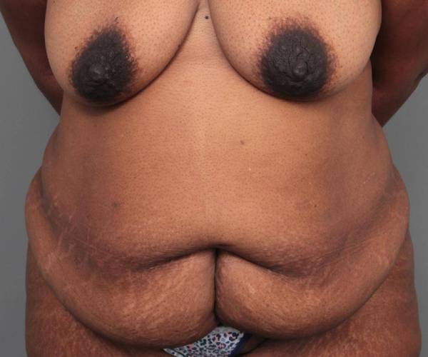 before tummy tuck female patient front view case 4295
