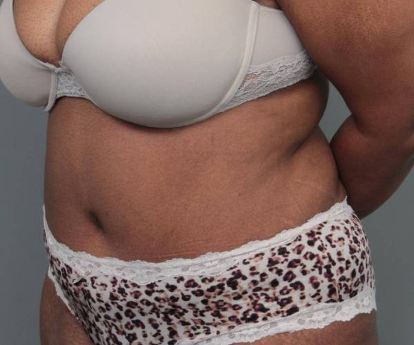 after tummy tuck female patient left angle view case 4295