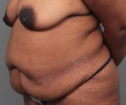 before tummy tuck female patient left angle view case 4295