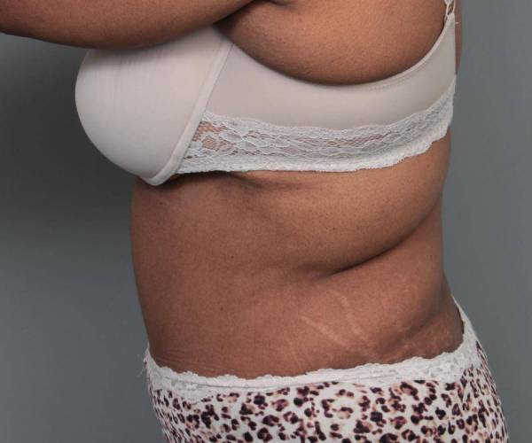 after tummy tuck female patient left side view case 4295