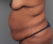 before tummy tuck female patient left side view case 4295