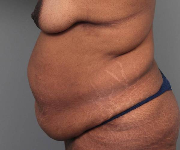before tummy tuck female patient left side view case 4295