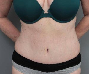 after tummy tuck female patient front view case 4305