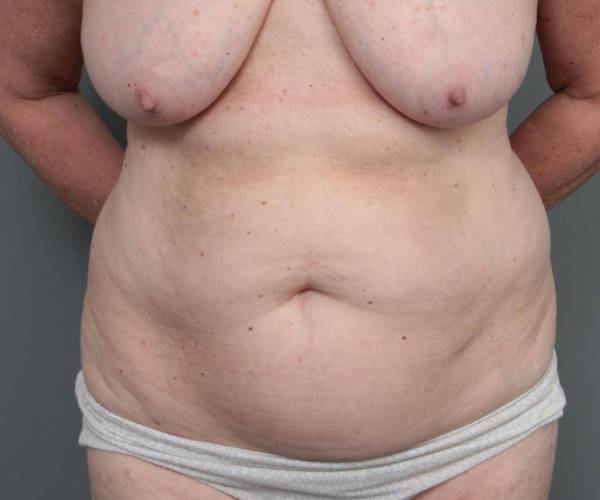 before tummy tuck female patient front view case 4305