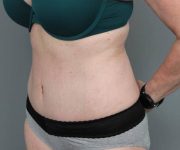 after tummy tuck female patient left angle view case 4305