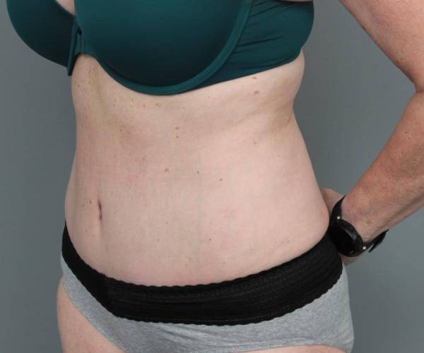 after tummy tuck female patient left angle view case 4305