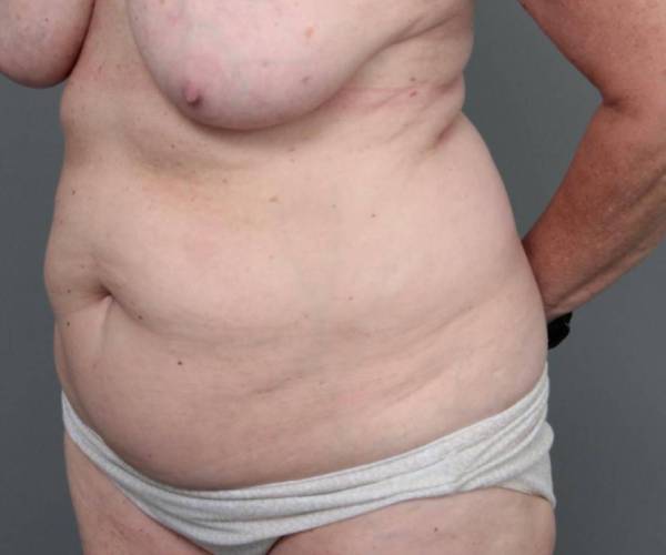 before tummy tuck female patient left angle view case 4305