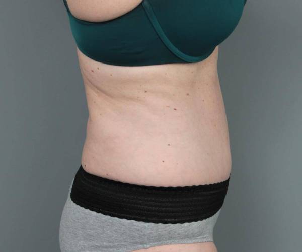 after tummy tuck female patient right side view case 4305