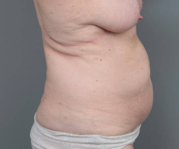 before tummy tuck female patient right side view case 4305