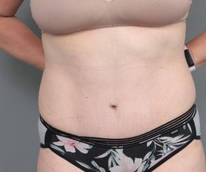 after tummy tuck female patient front view case 4312