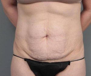 before tummy tuck female patient front view case 4312