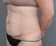 before tummy tuck female patient left angle view case 4312