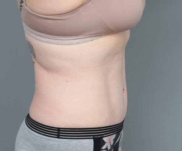 after tummy tuck female patient right side view case 4312