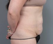 before tummy tuck female patient right side view case 4312