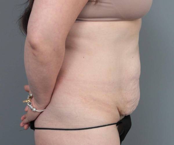 before tummy tuck female patient right side view case 4312