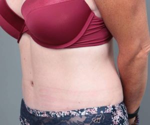 after tummy tuck female patient left angle view case 4319