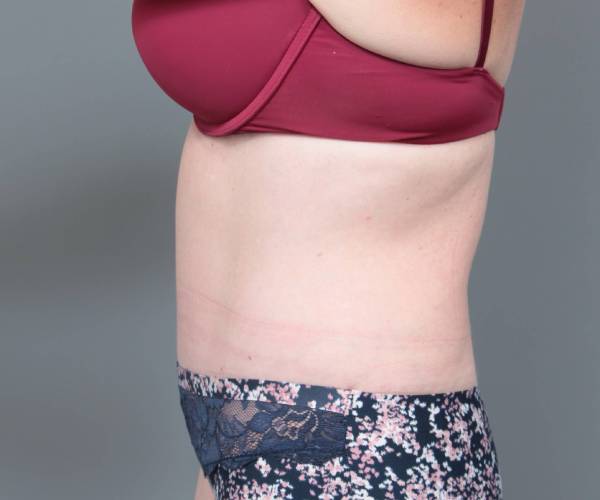 after tummy tuck female patient left side view case 4319