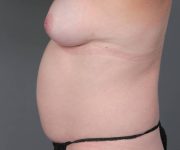 before tummy tuck female patient left side view case 4319