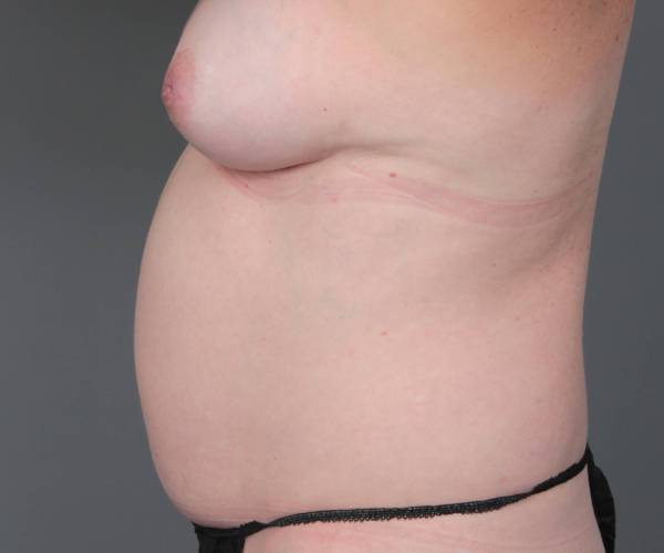 before tummy tuck female patient left side view case 4319