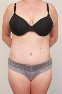 after tummy tuck female patient front view case 4324