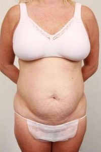 before tummy tuck female patient front view case 4324