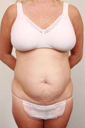 before tummy tuck female patient front view case 4324