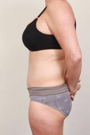 after tummy tuck female patient left side view case 4324