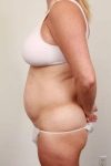before tummy tuck female patient left side view case 4324