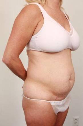 before tummy tuck female patient right angle view case 4324